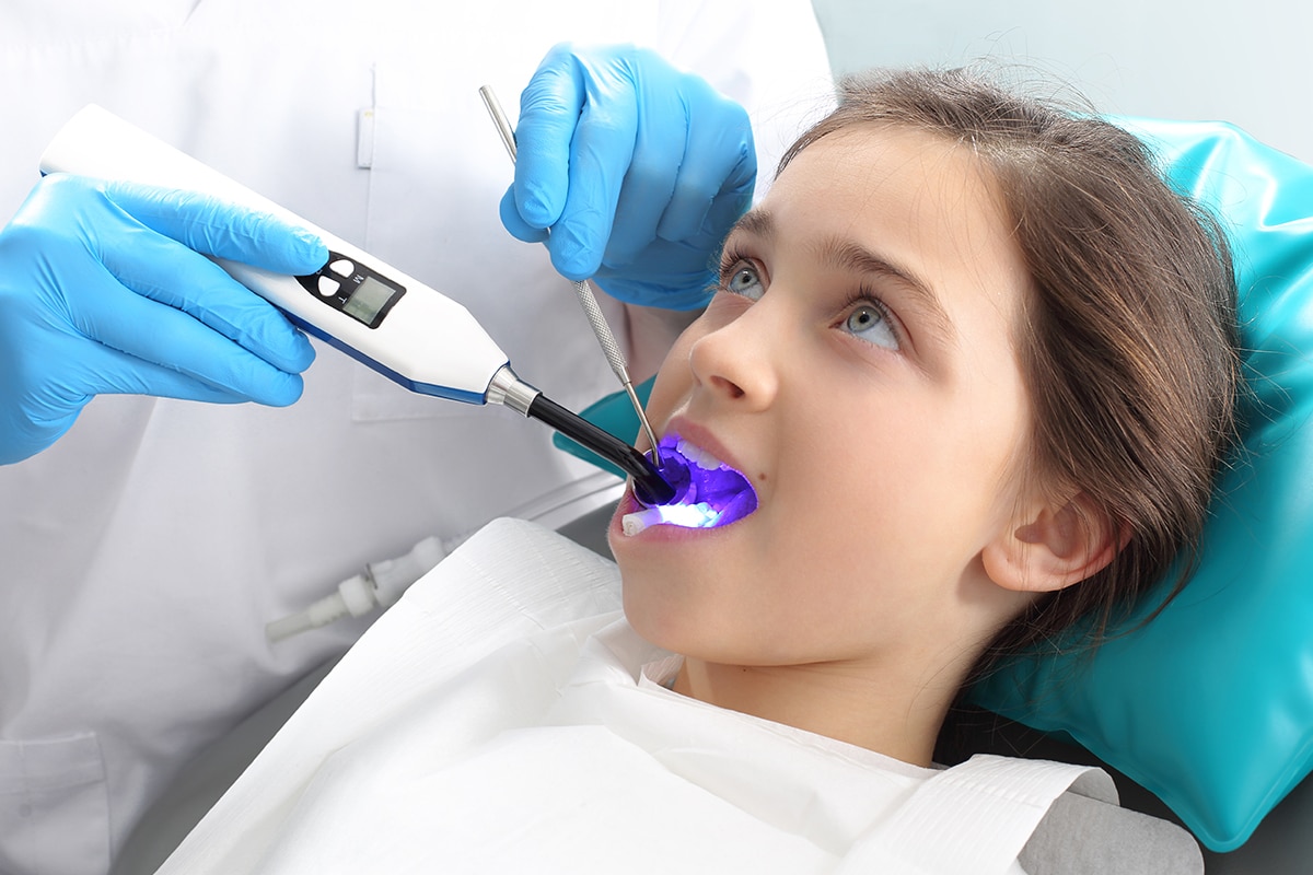 How Sealants Help Prevent Cavities In Children And Adults Blog